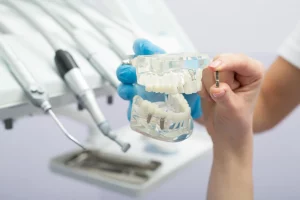 dental implants model