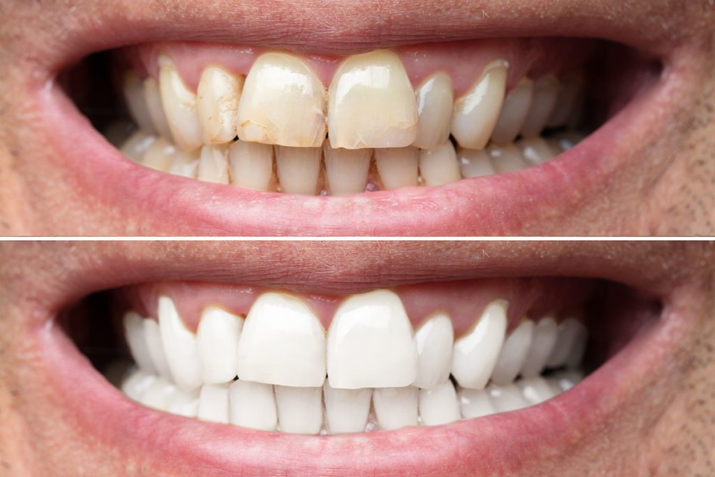 Whitening Teeth Before and After.