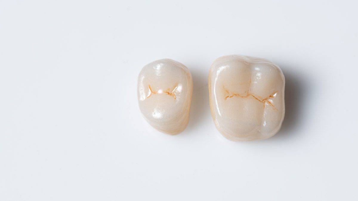 Dental crown image side-by-side